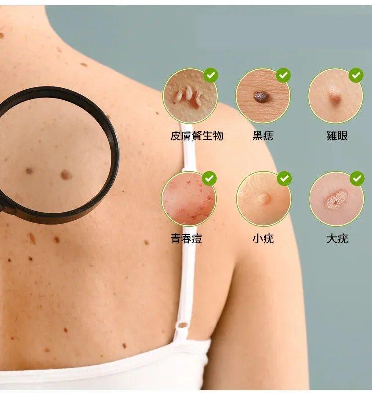 黃輔堂點痣膏