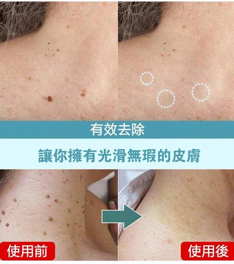 黃輔堂點痣膏