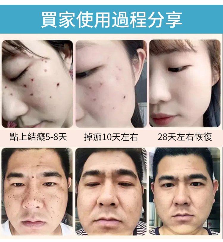 黃輔堂點痣膏